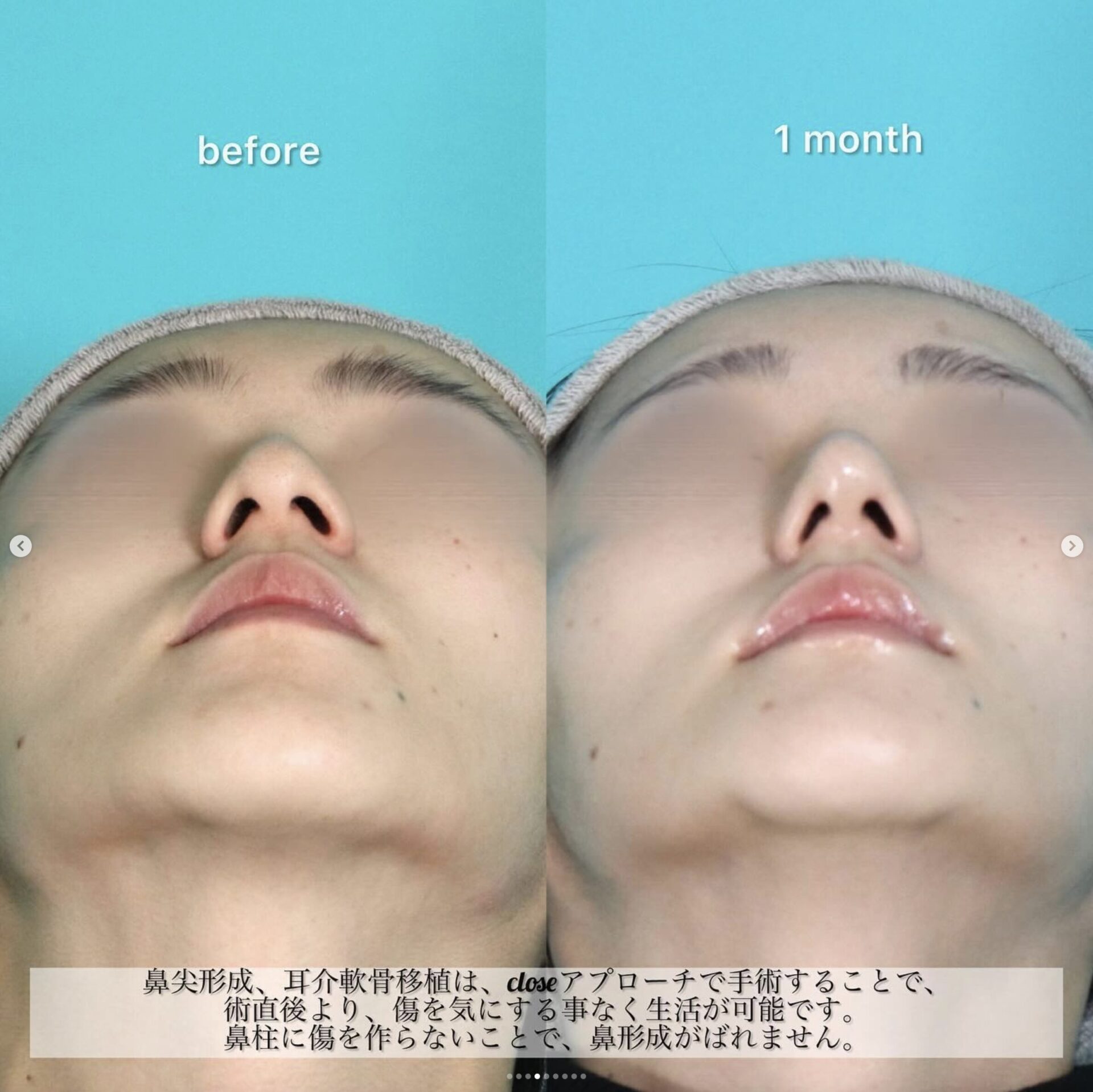 中抜き、鼻尖形成、耳介軟骨移植施術前後イメージ