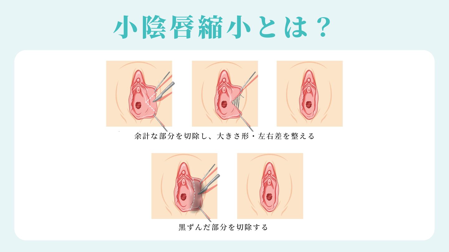 小陰唇縮小術とは？