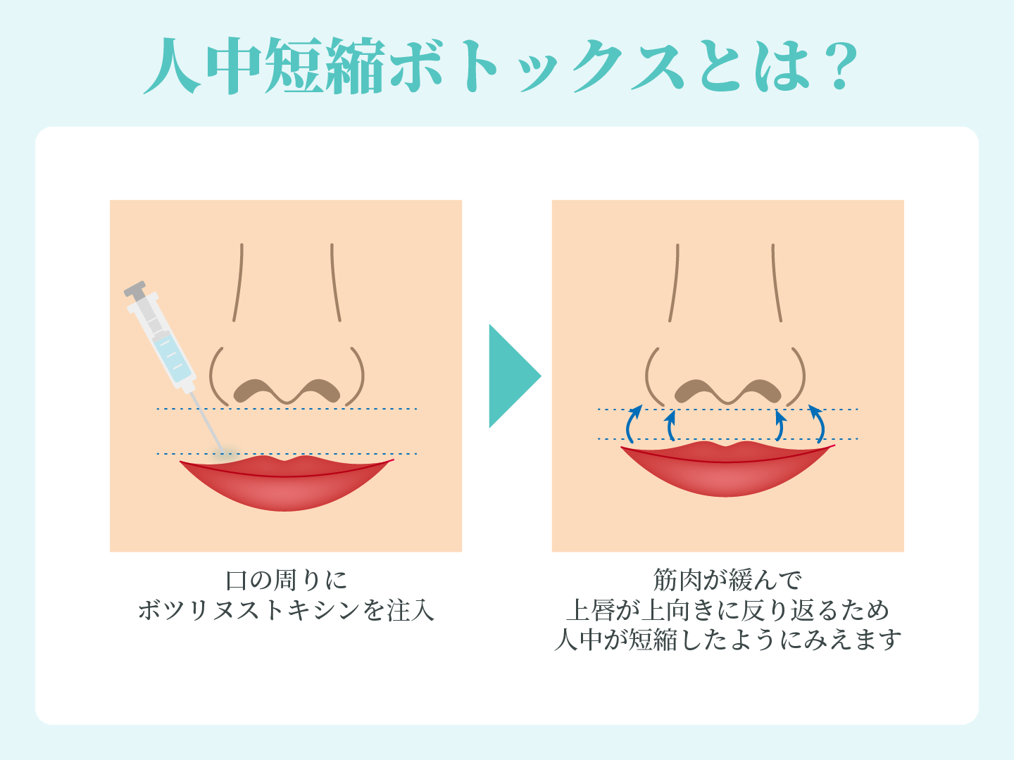 人中短縮ボトックスとは？