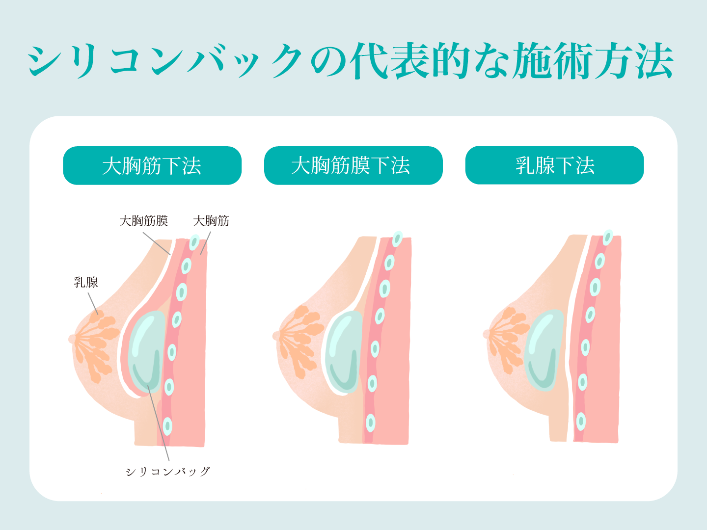 シリコンバックの代表的な施術方法