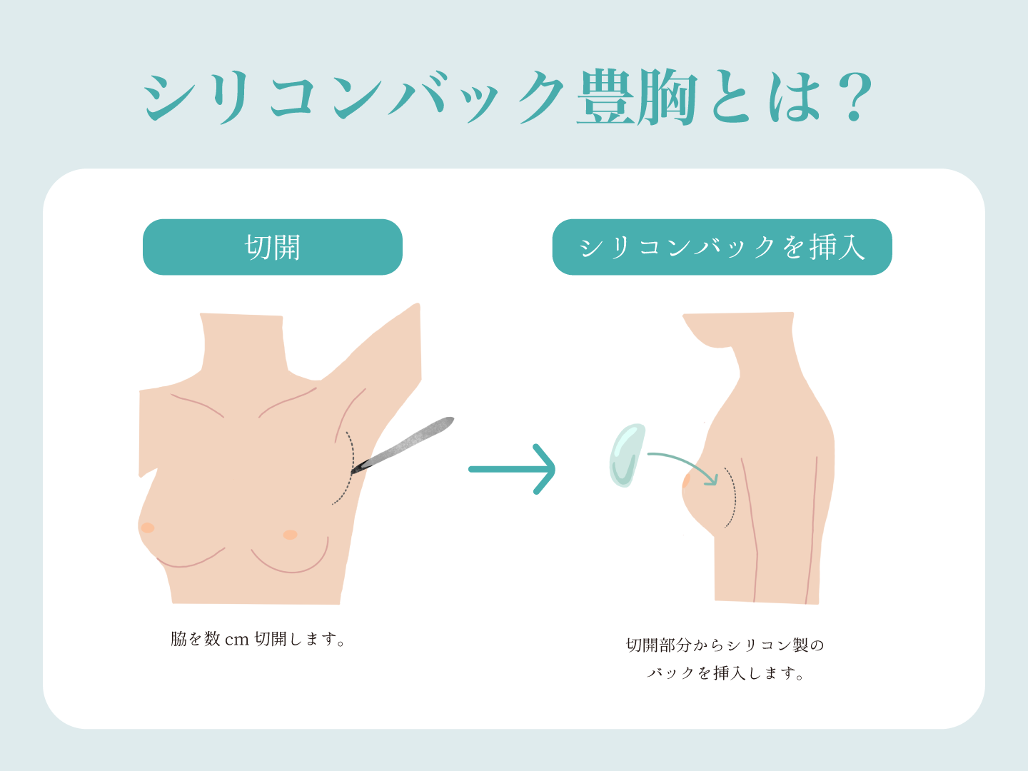 シリコンバック豊胸とは