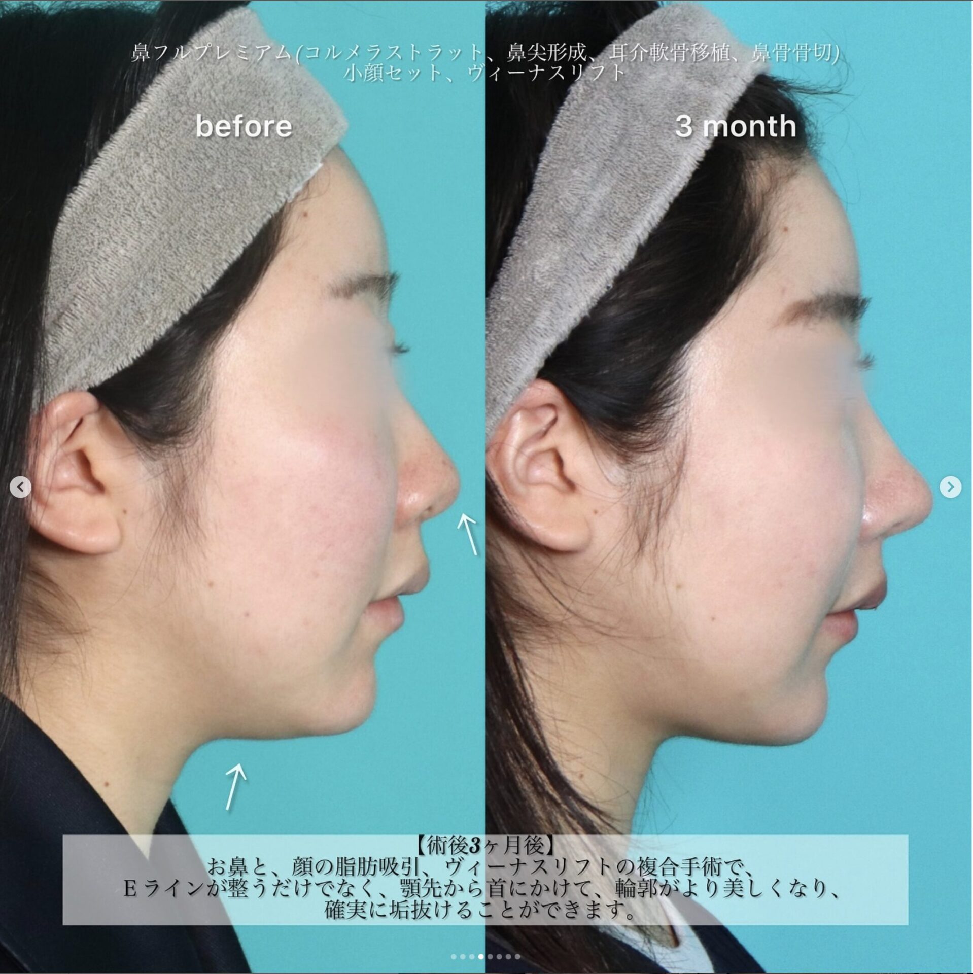 鼻フルコースプレミアム、小顔セット、糸リフト施術前後イメージ