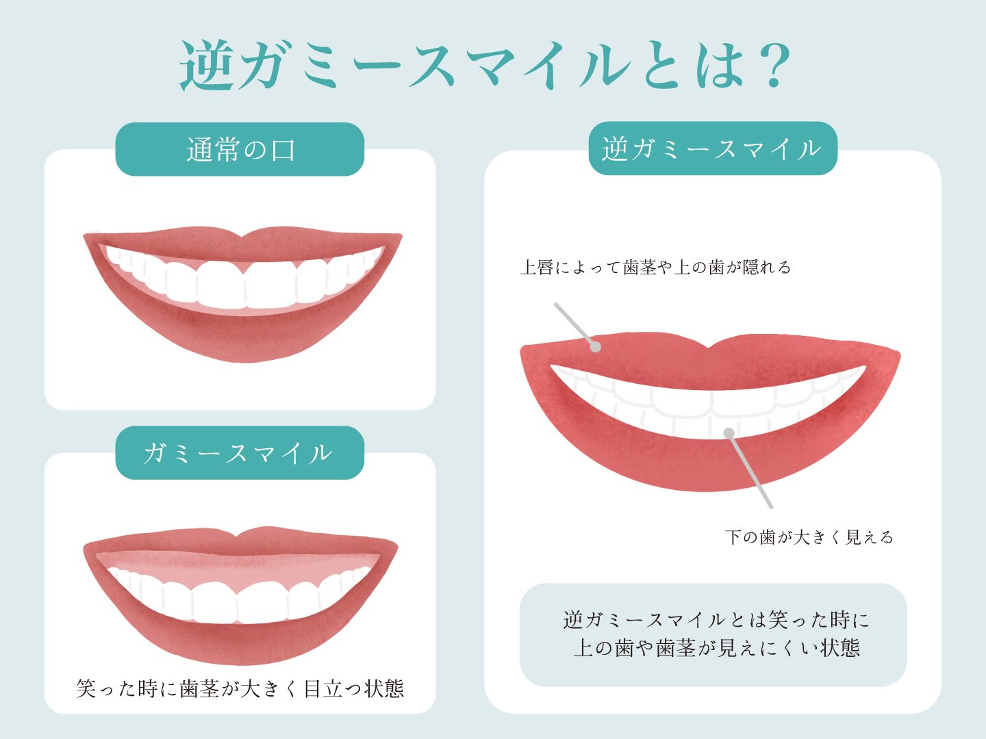 逆ガミースマイルとは？