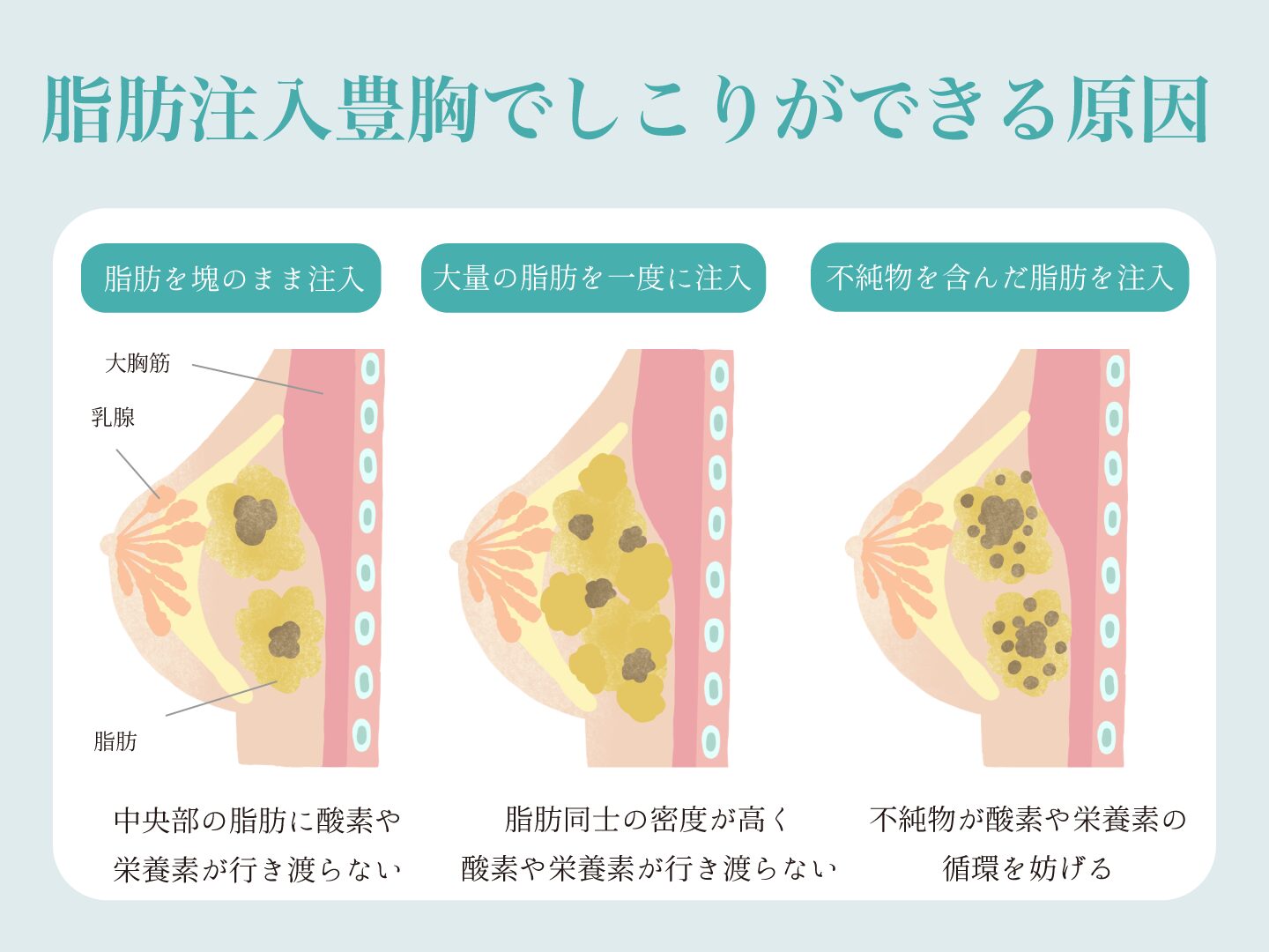 脂肪注入豊胸でしこりができる原因