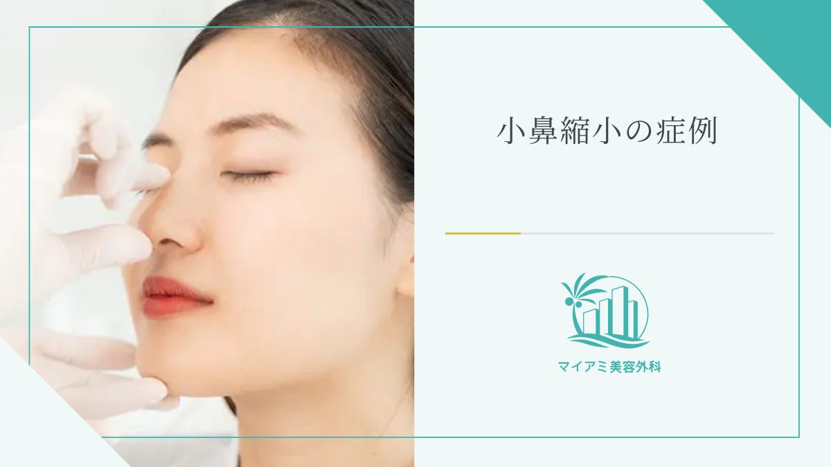 小鼻縮小の症例