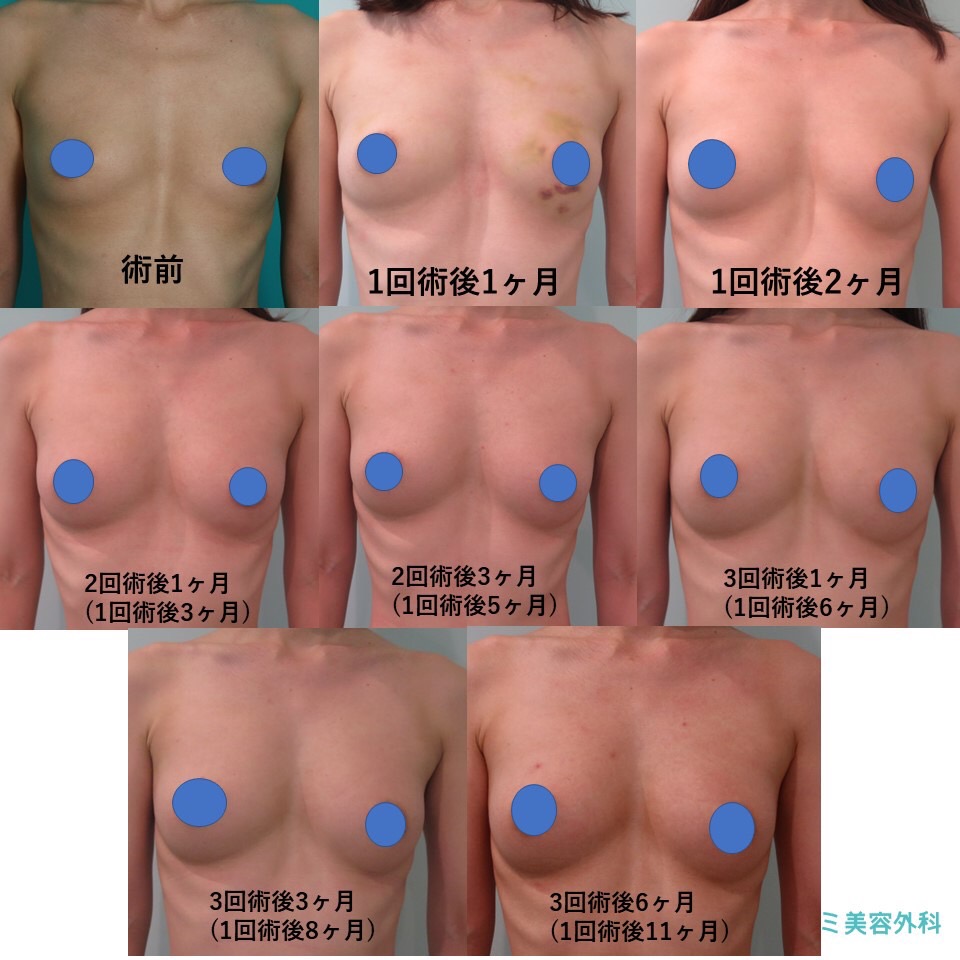 ばれない豊胸施術前後イメージ