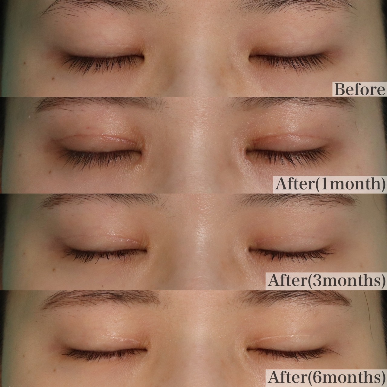 二重全切開、目頭切開施術前後イメージ
