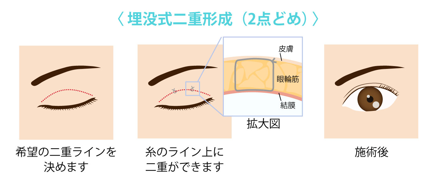 埋没式二重形成２点留め