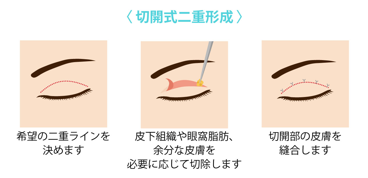 切開式二重整形