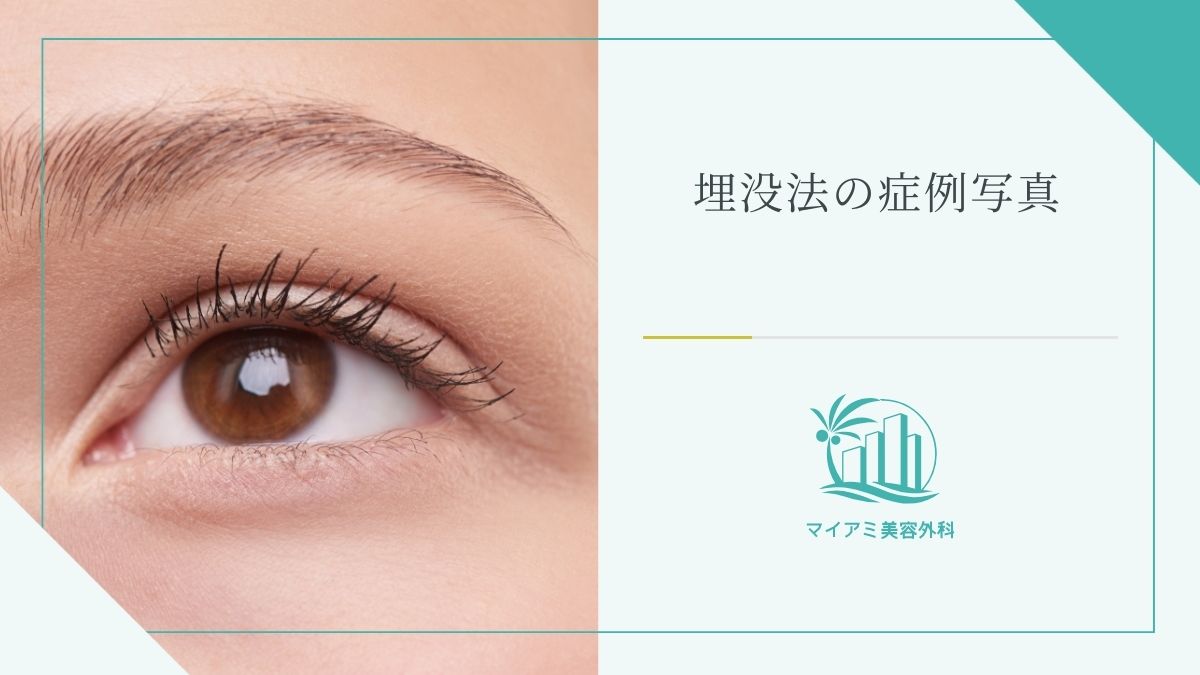埋没法の症例写真