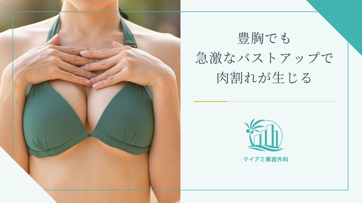 豊胸でも急激なバストアップで肉割れが生じる