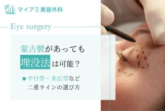 蒙古襞があっても埋没法は可能？平行型・末広型など二重ラインの選び方