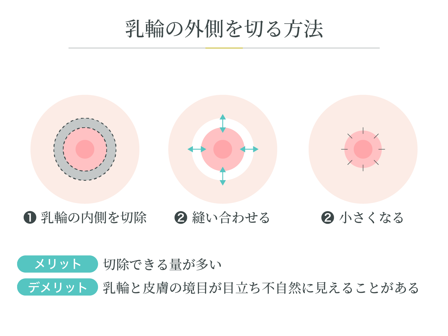 illustration_乳輪縮小_乳輪の外側を切る方法