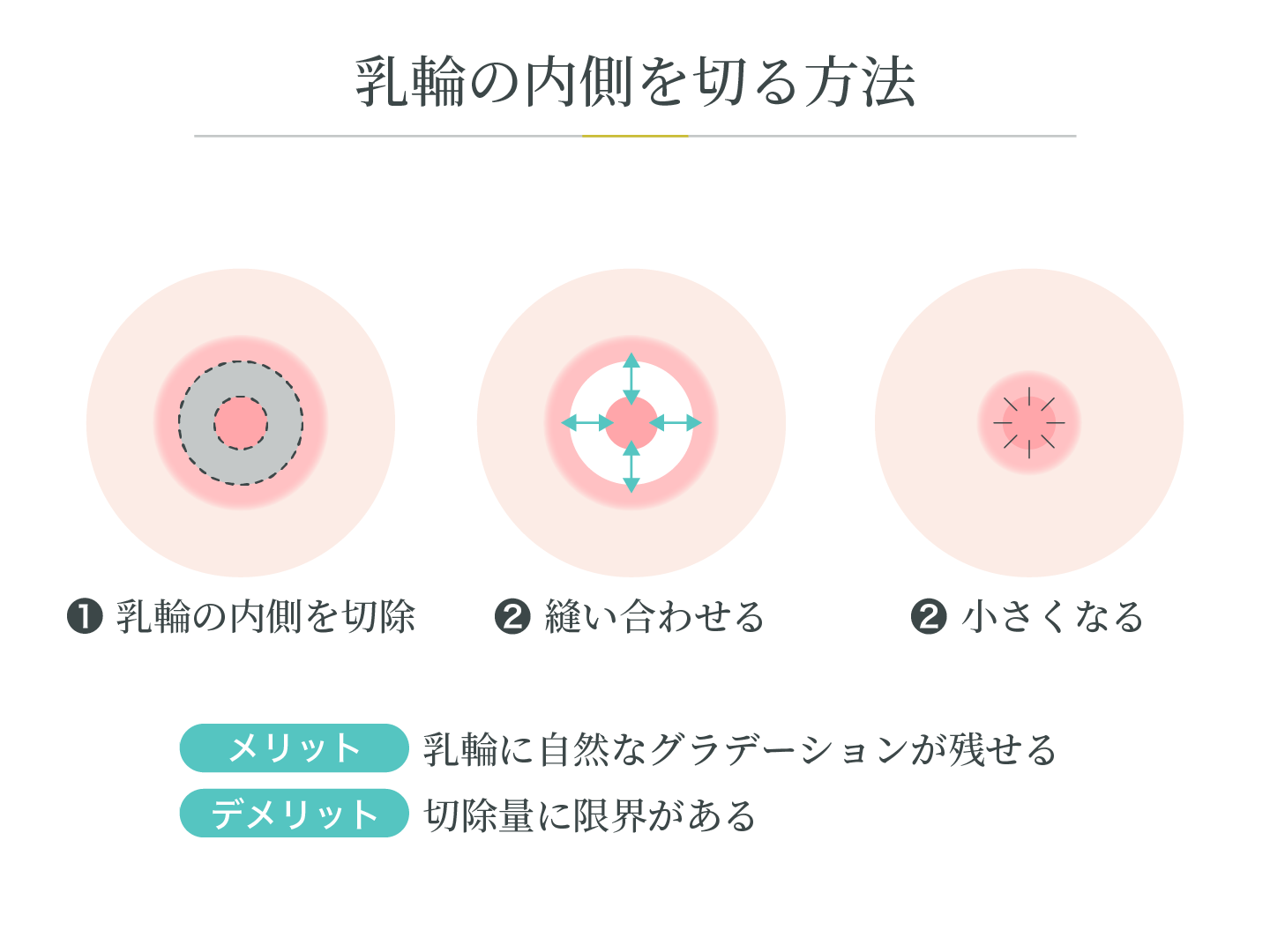 illustration_乳輪縮小_乳輪の内側を切る方法