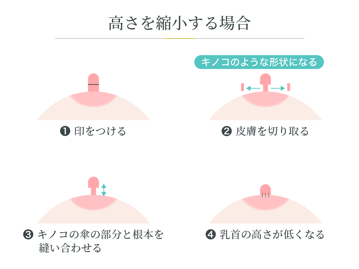 illustration_乳頭縮小_高さの縮小