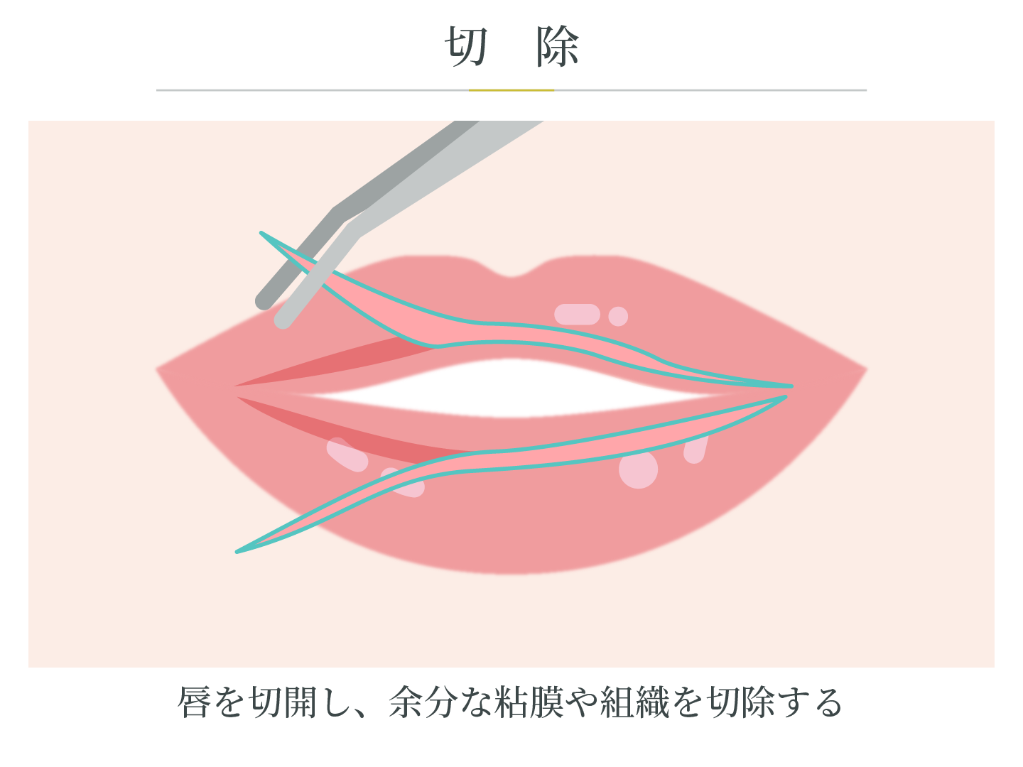 illustration_切除