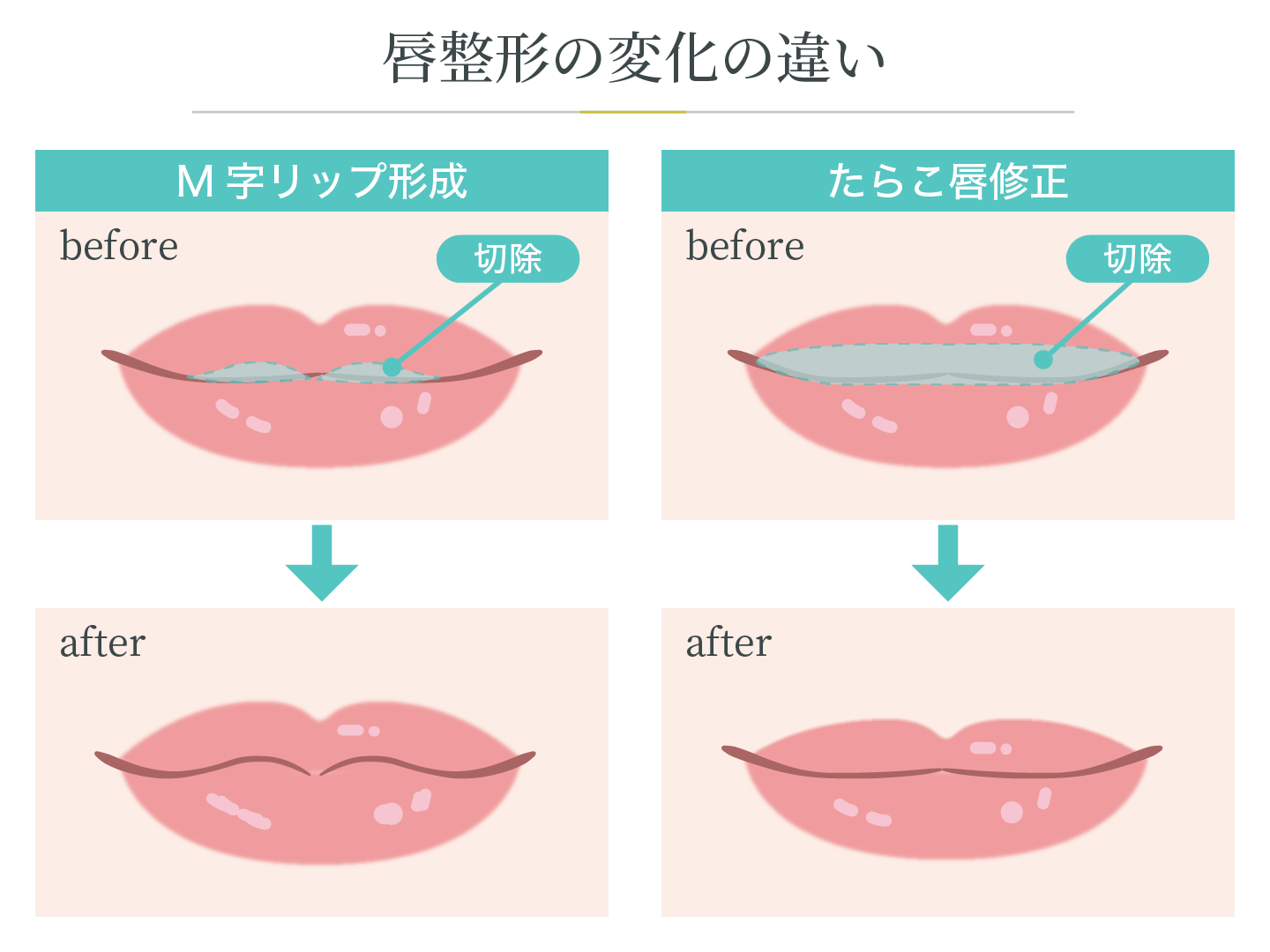illustration_唇整形の変化の違い