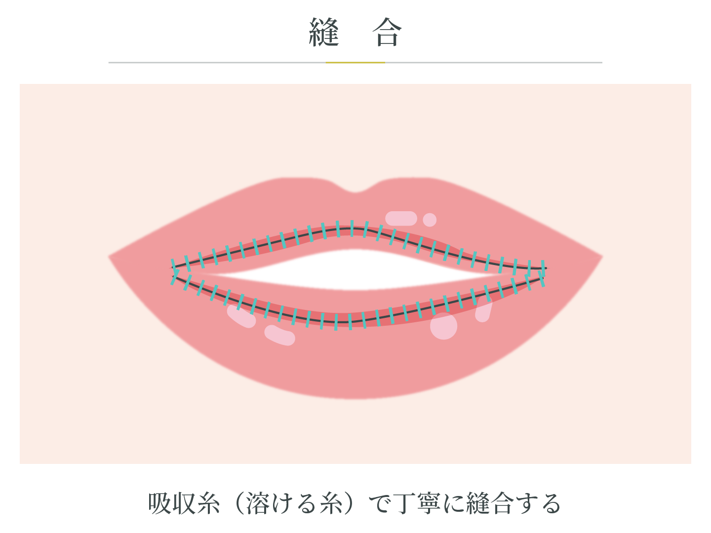 illustration_縫合