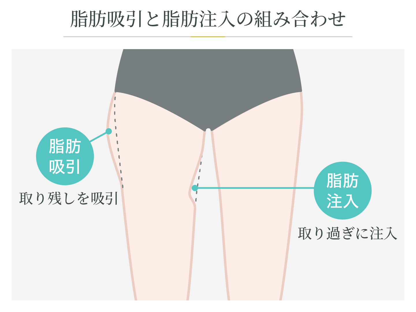 illustration_脂肪吸引と脂肪注入の組み合わせ