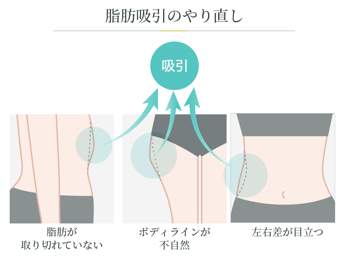 illustration_脂肪吸引のやり直し