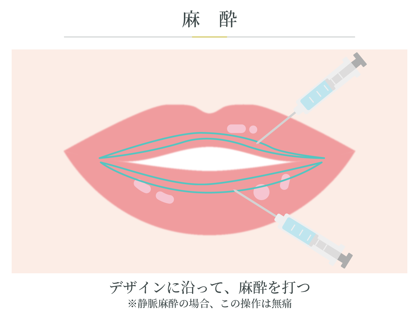 illustration_麻酔