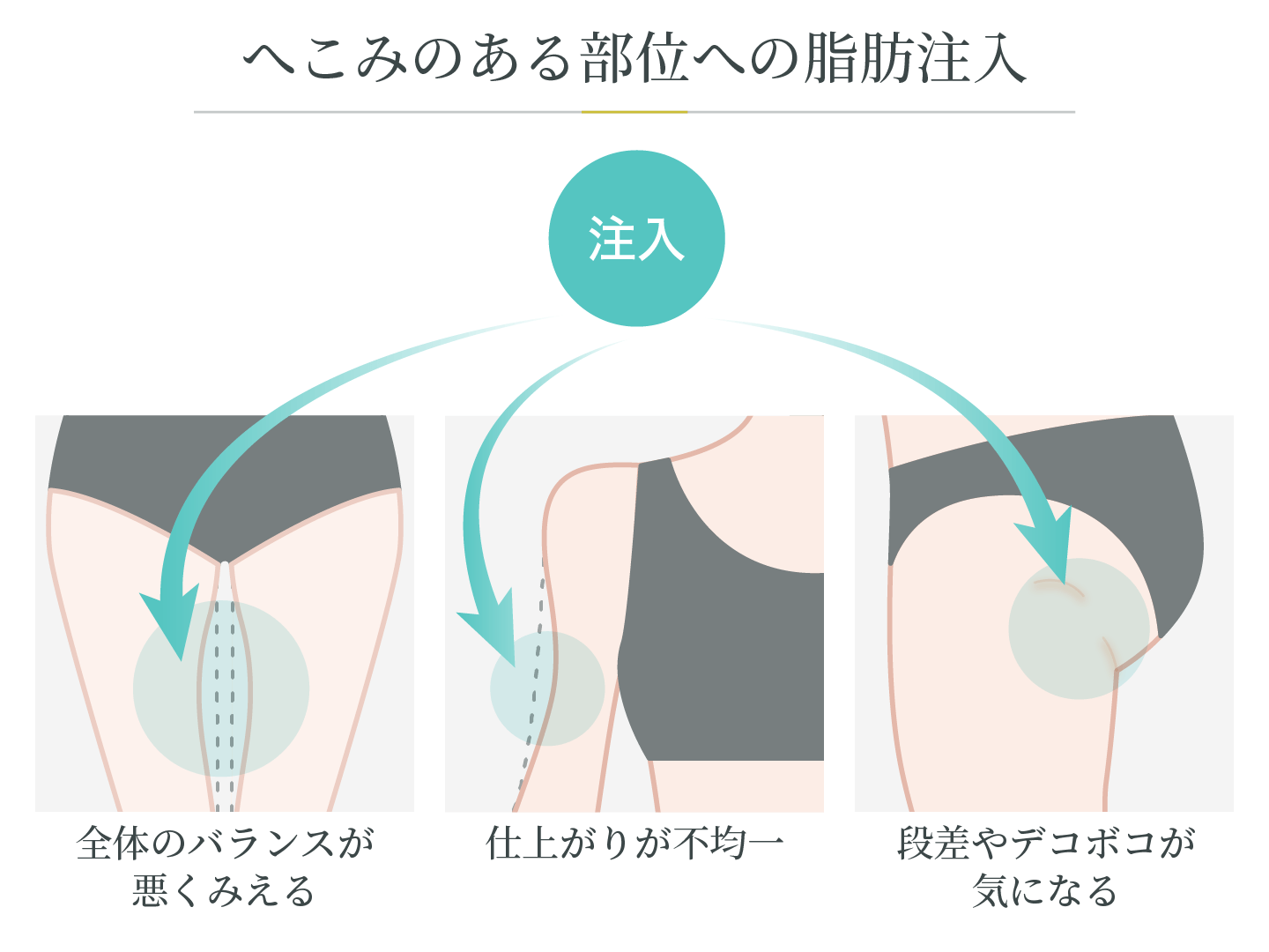 illustration_へこみのある部位への脂肪注入