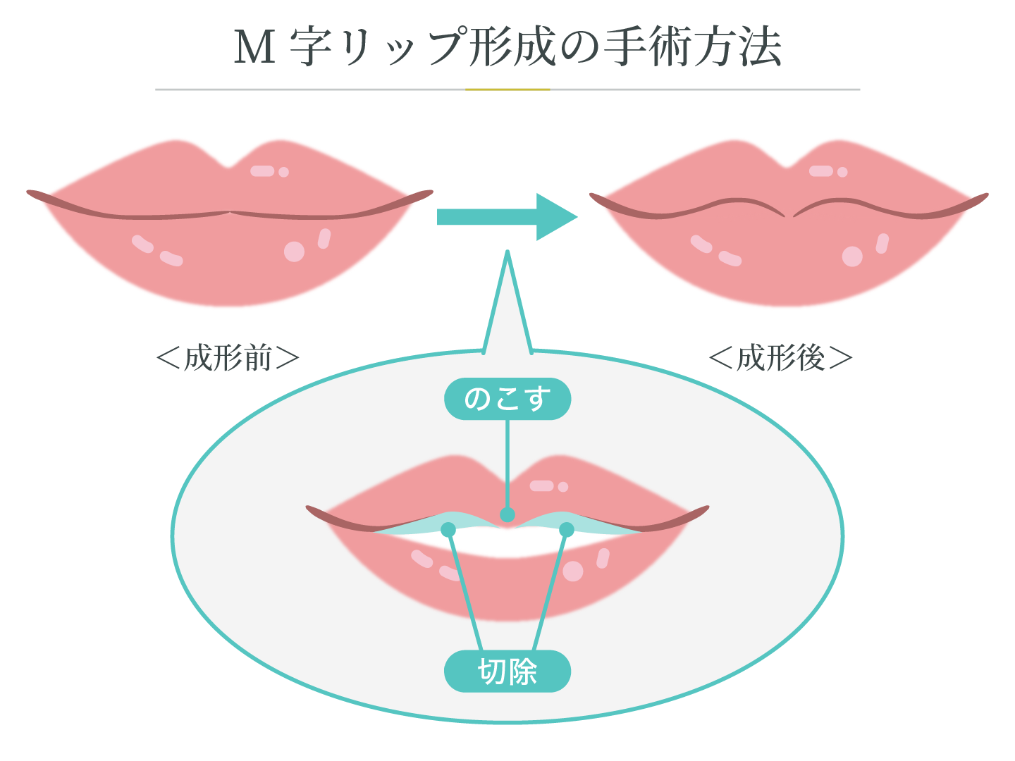 illustration_M字リップ形成の手術方法