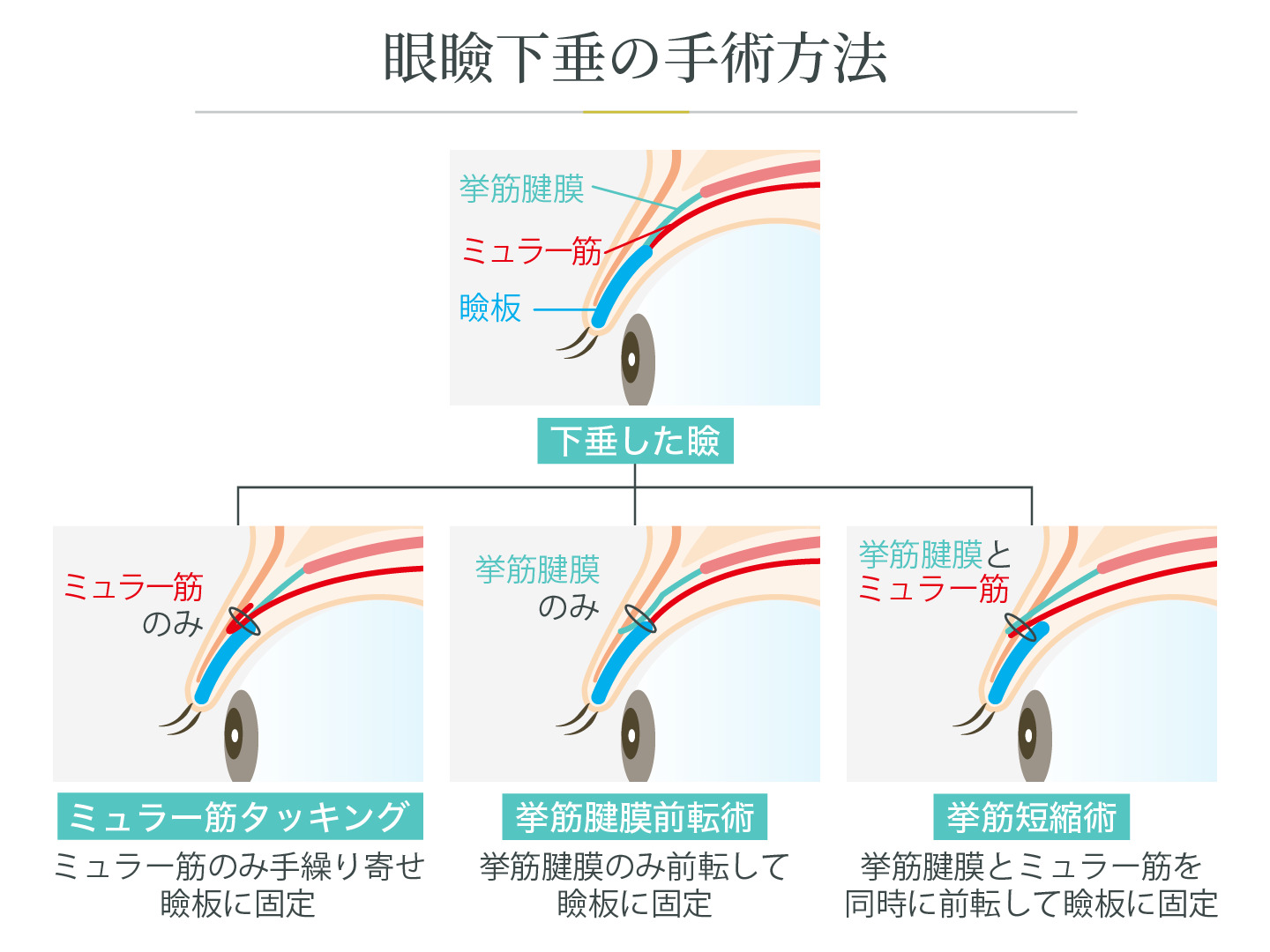 illustration_眼瞼下垂の手術方法