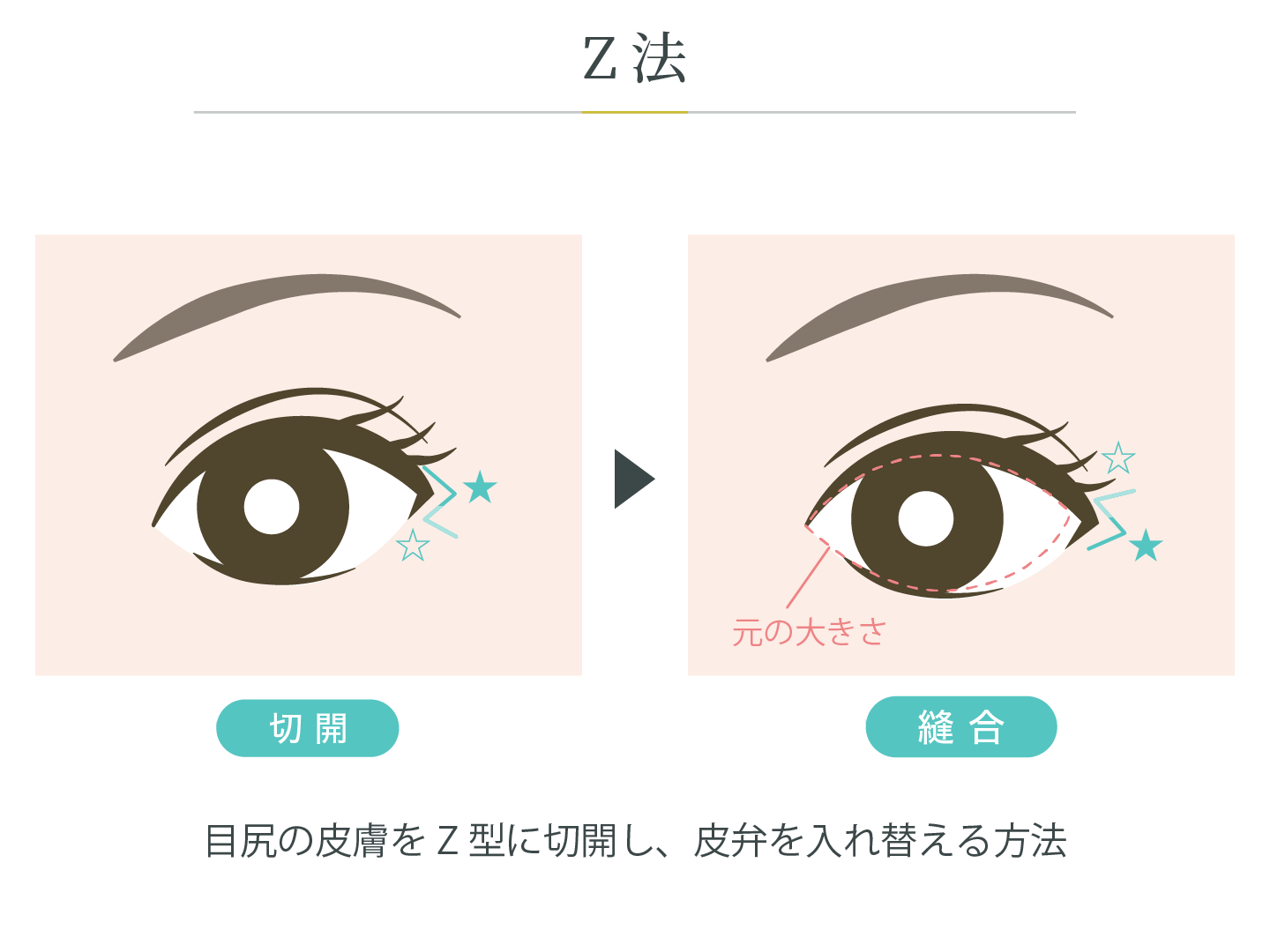 illustration_目尻_Z法