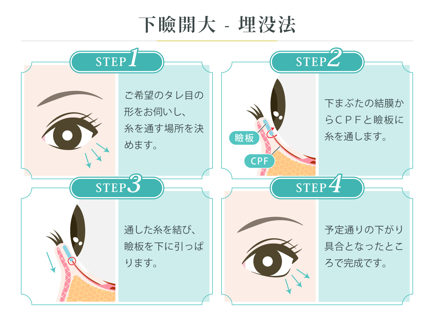 illustration_下瞼開大_埋没法