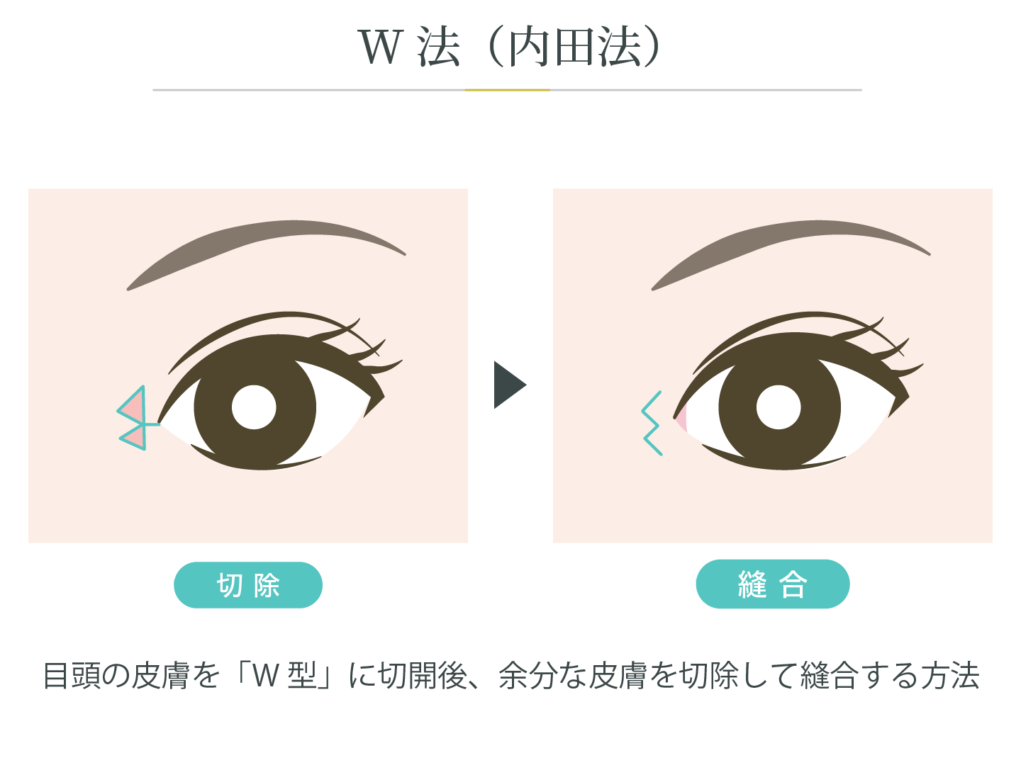 illustration_目頭_W法（内田法）