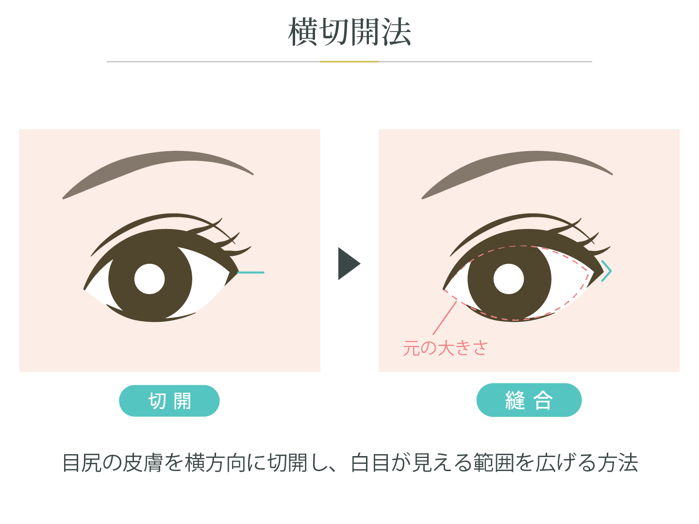 illustration_目尻_横切開法