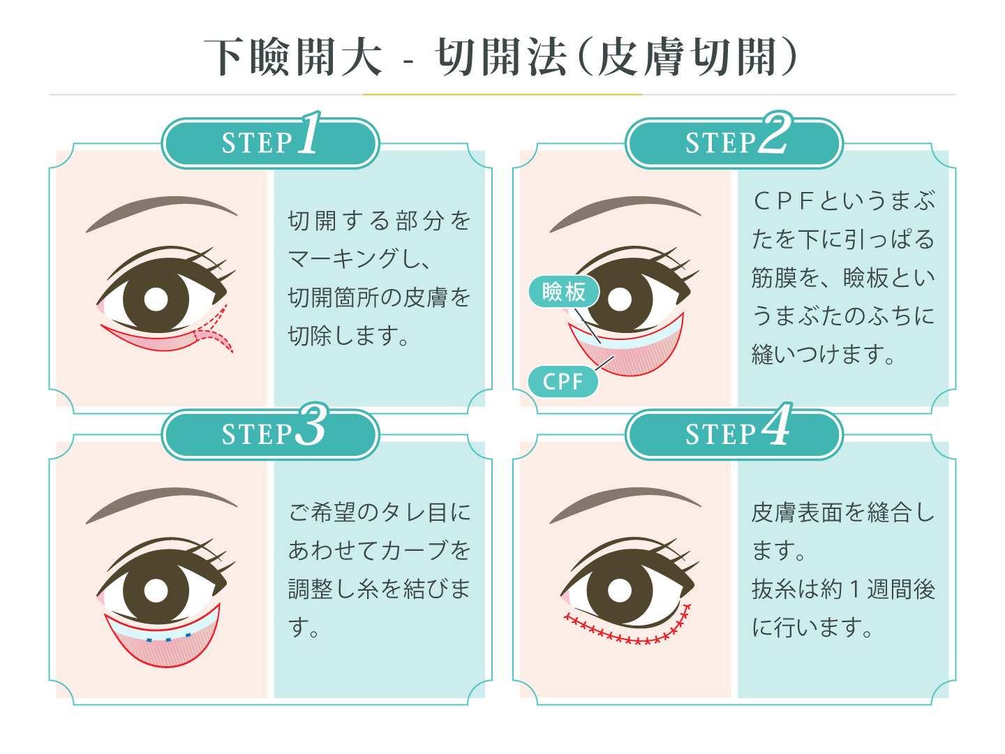 illustration_下瞼開大_切開法（皮膚切開）