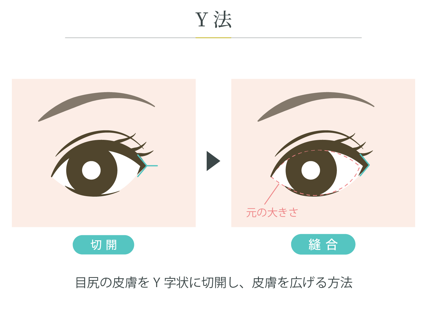 illustration_目尻_Y法