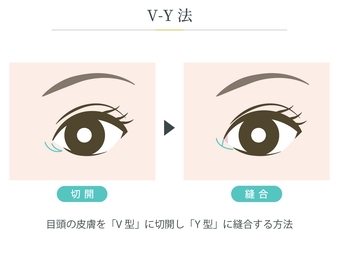 illustration_目頭_V-Y法