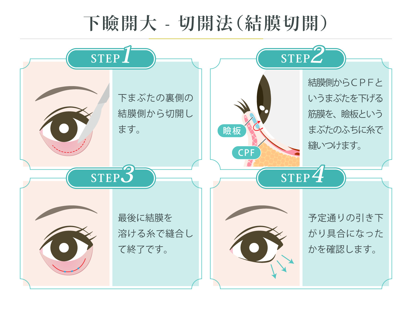illustration_下瞼開大_切開法（結膜切開）