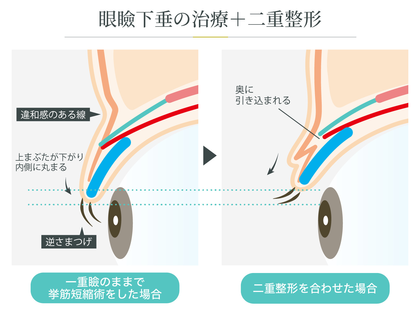 illustration_眼瞼下垂の治療＋二重整形
