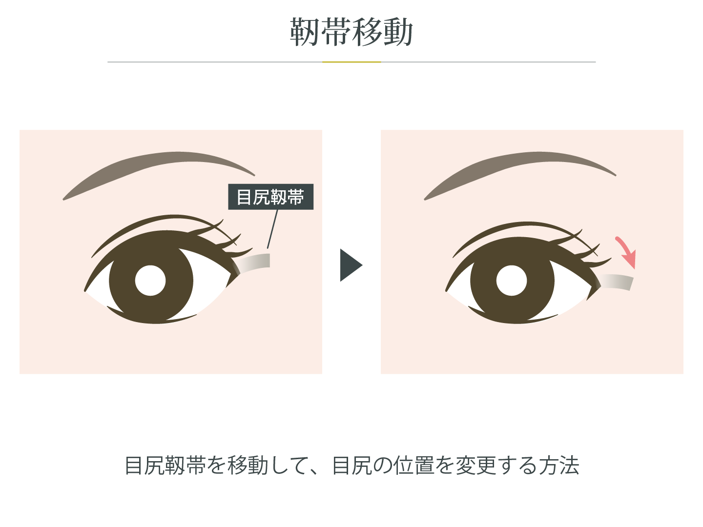 illustration_目尻_靱帯移動