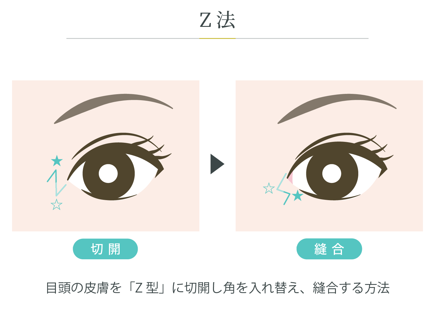 illustration_目頭_Z法