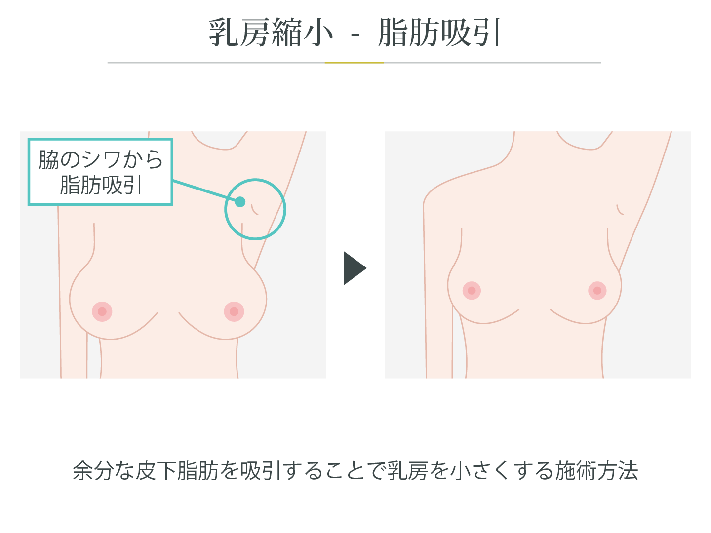 illustration_乳房縮小_脂肪吸引