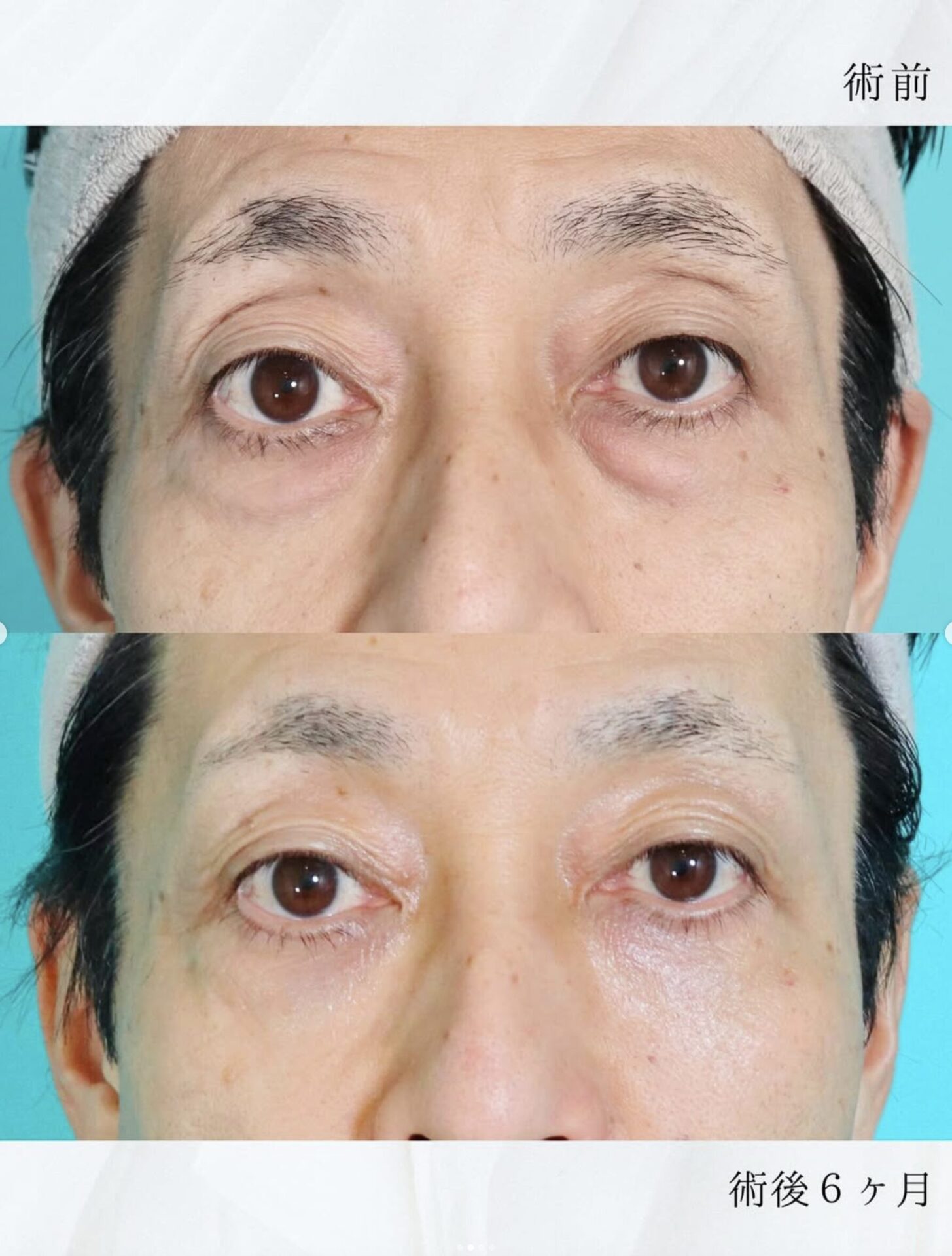 下瞼たるみ取り　５０代男性施術前後イメージ