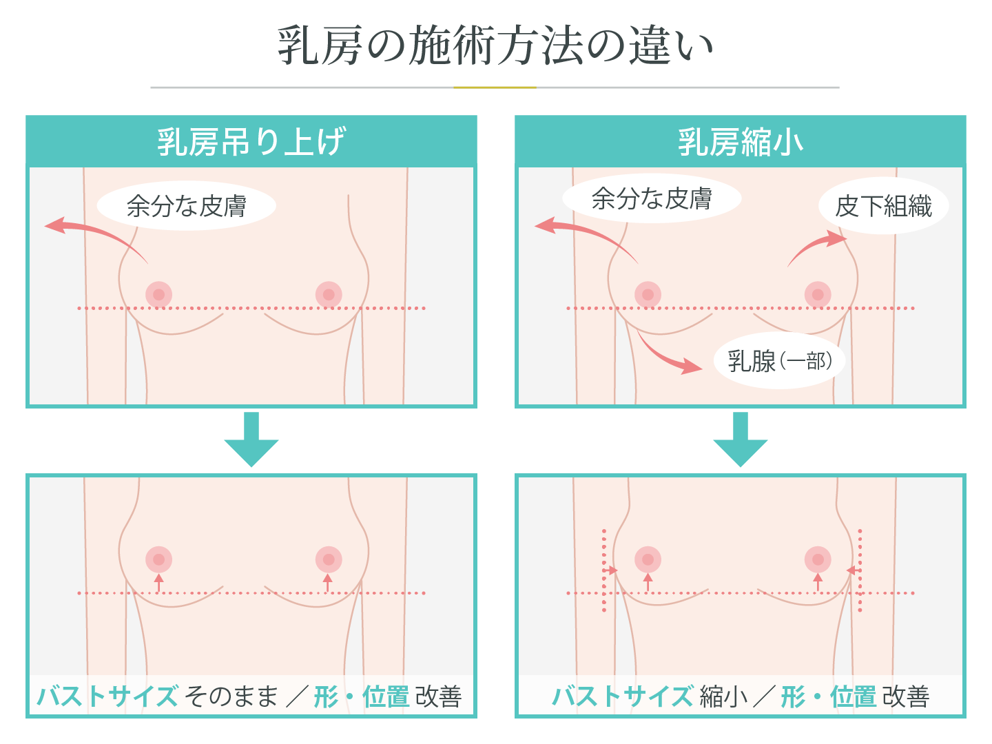 illustration_乳房の施術方法の違い