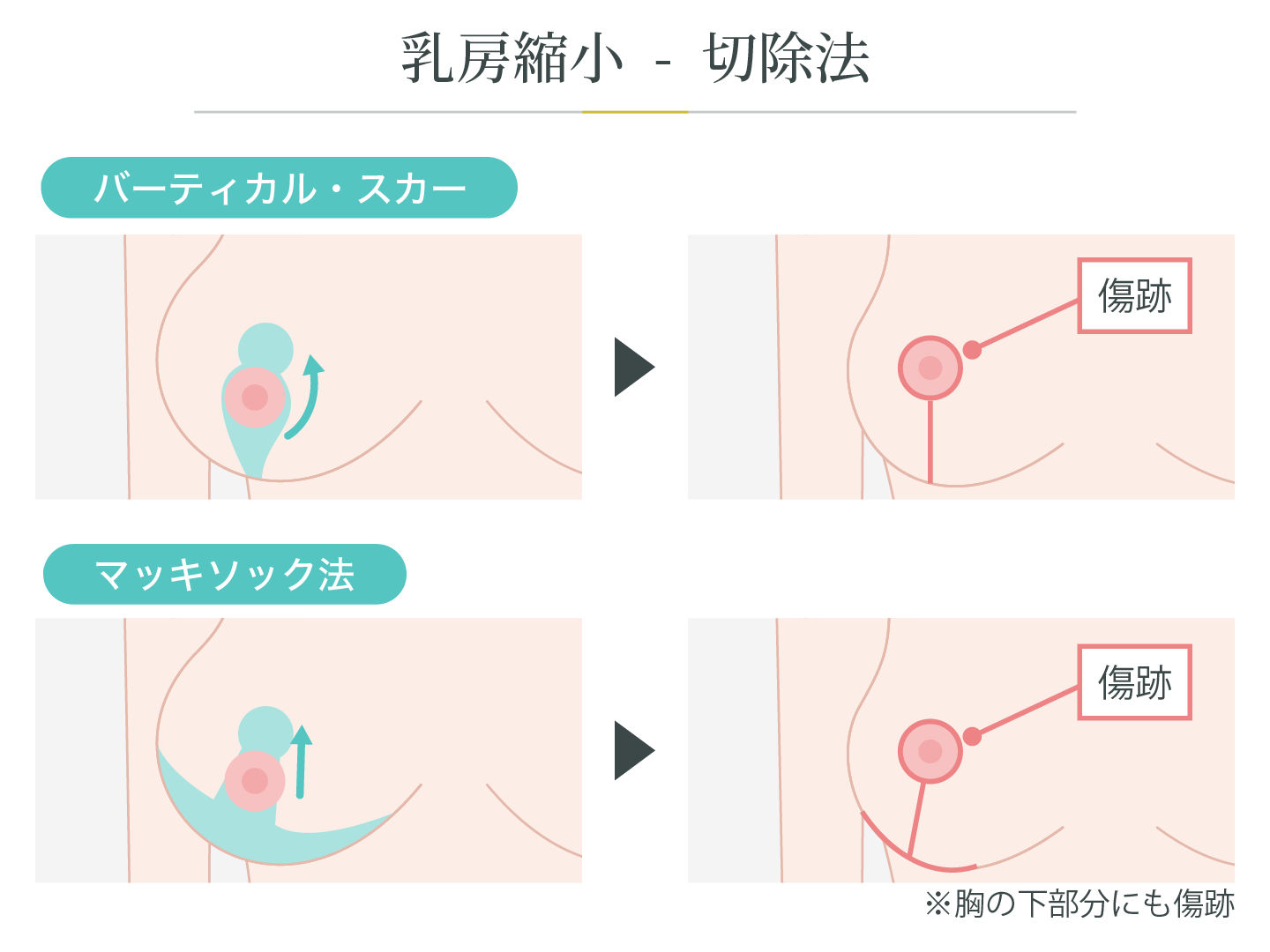 乳房縮小の手術方法