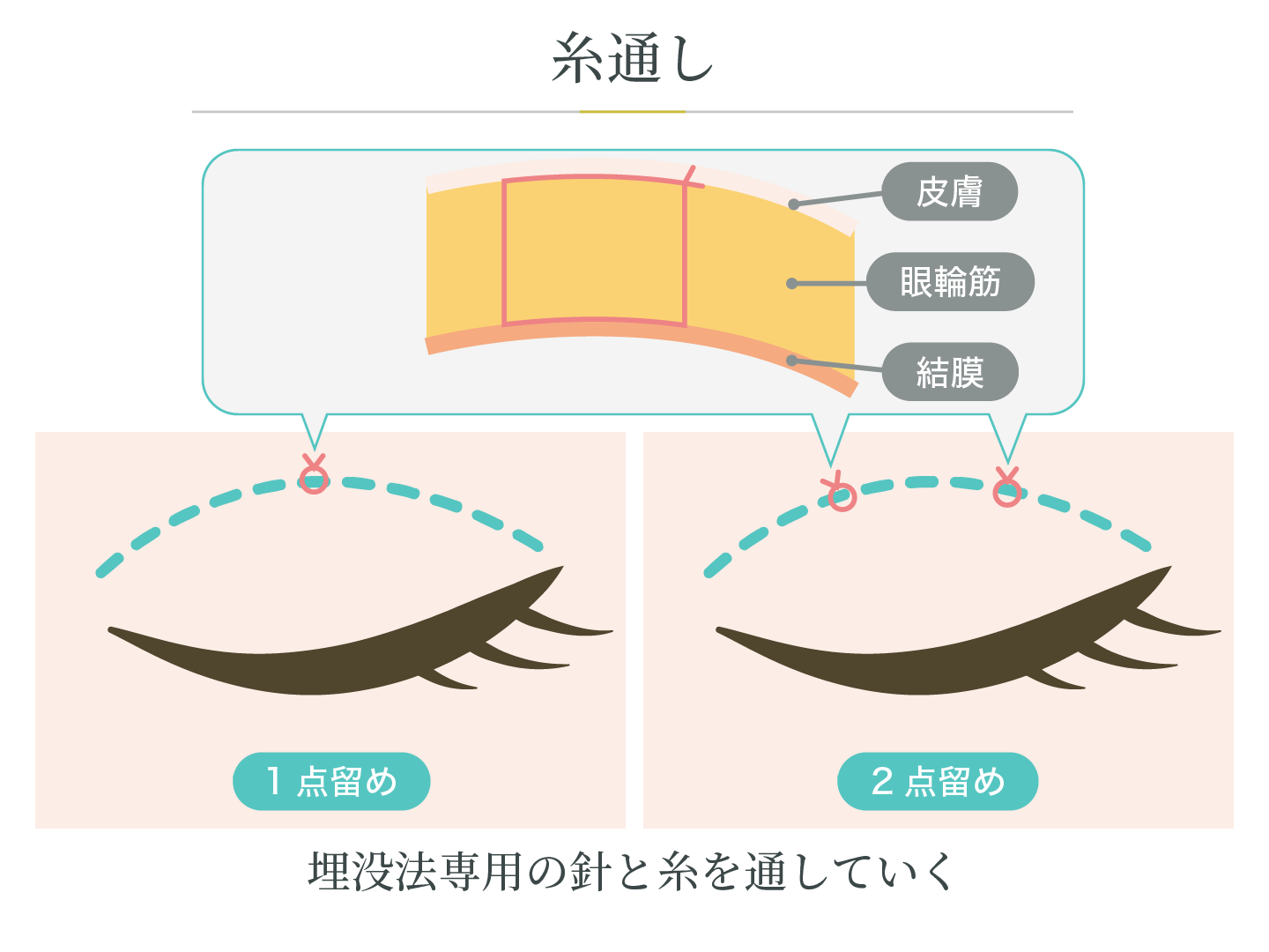 illustration_二重埋没法_糸通し