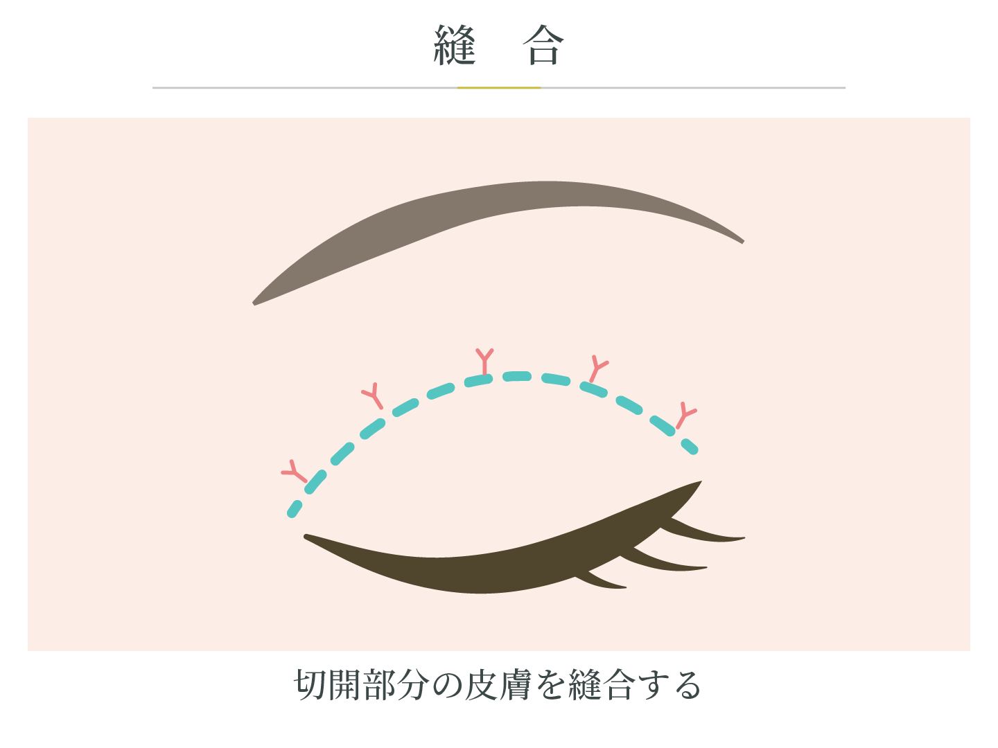 illustration_二重切開法_縫合