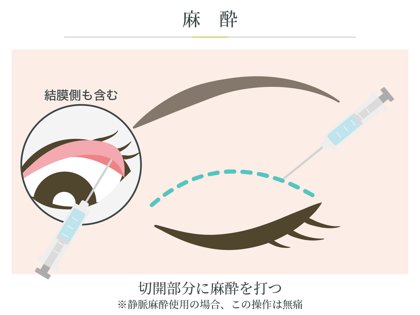 illustration_二重埋没法_麻酔