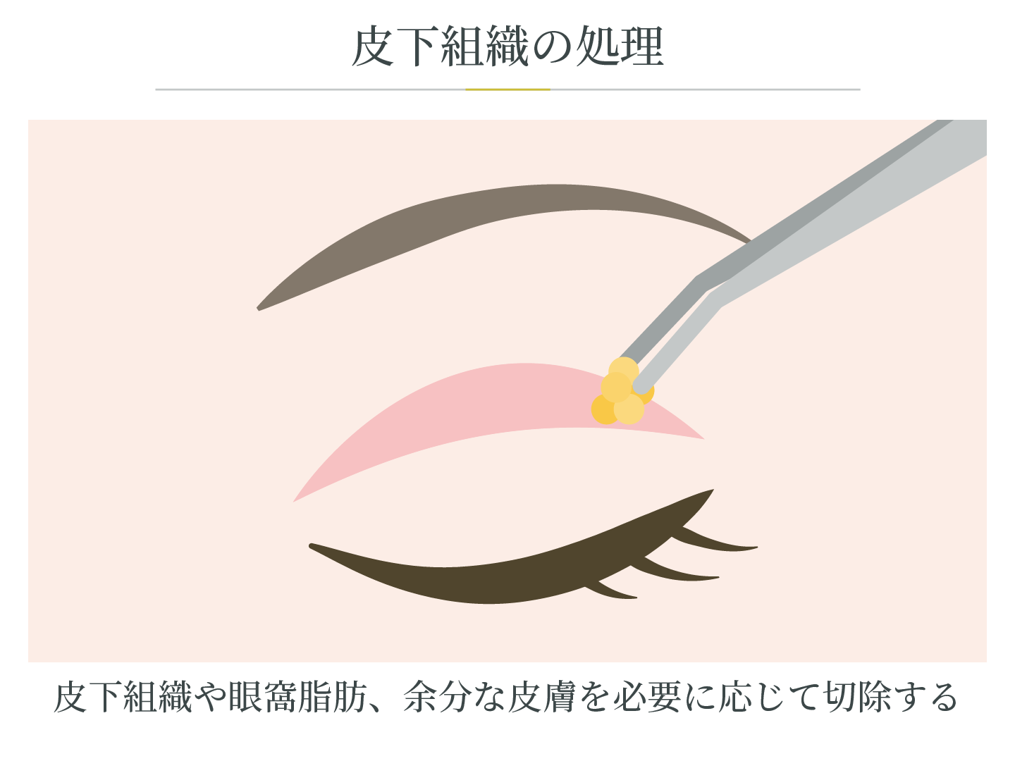 illustration_二重切開法_皮膚組織の処理