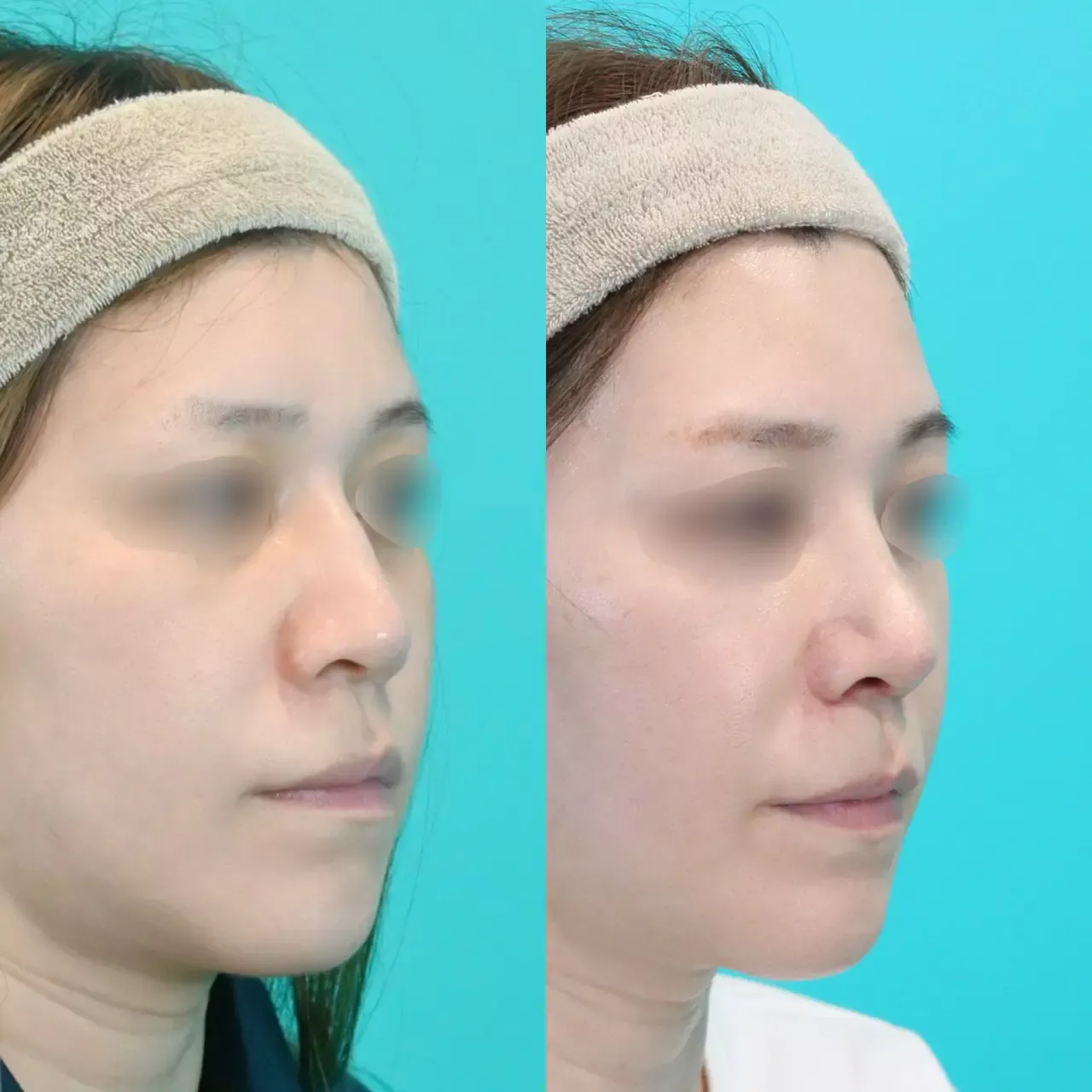 施術前後イメージ