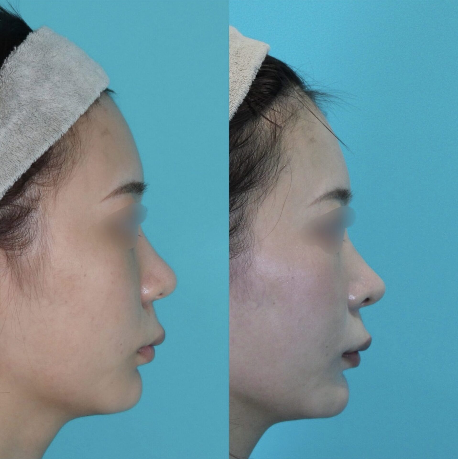 施術前後イメージ