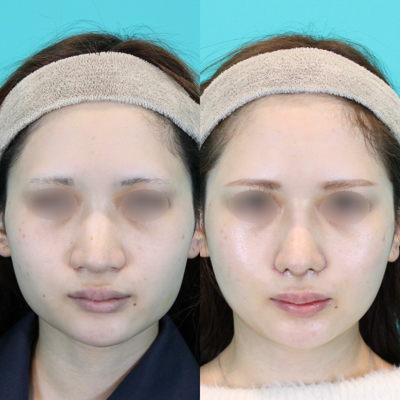 施術前後イメージ